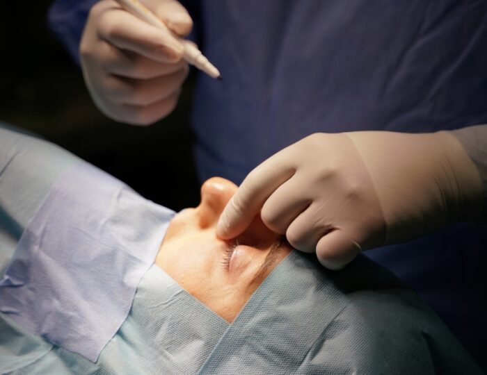 Estetica e Sorriso - Rinoplastica