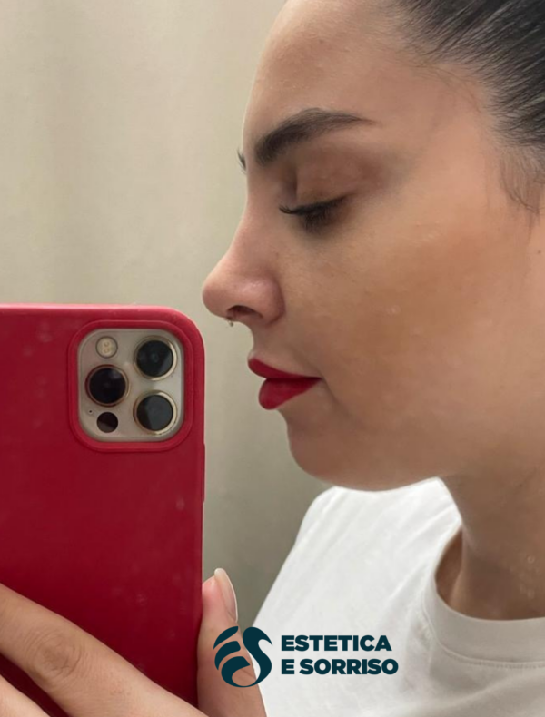 Rinoplastica - Estetica e Sorriso