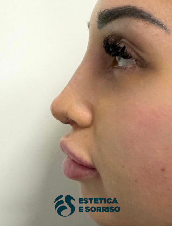 Rinoplastica - Estetica e Sorriso