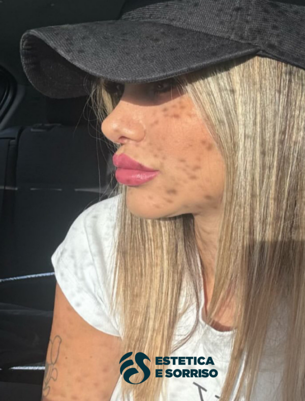 Rinoplastica - Estetica e Sorriso