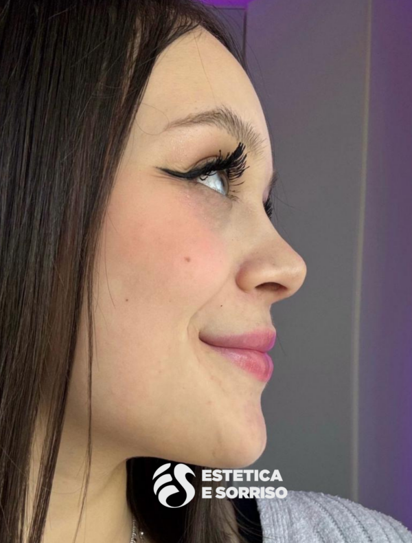 Rinoplastica - Estetica e Sorriso