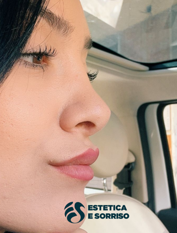 Rinoplastica - Estetica e Sorriso