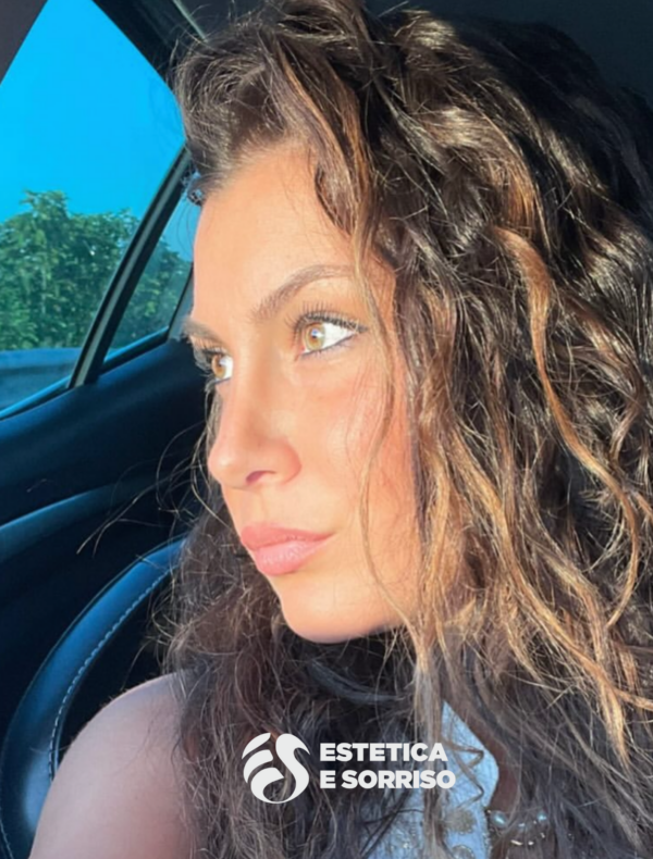 Rinoplastica - Estetica e Sorriso